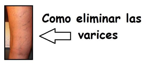 como eliminar las varices
