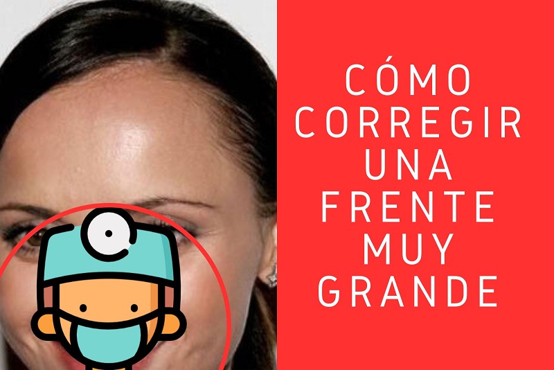frontoplastia de reducción