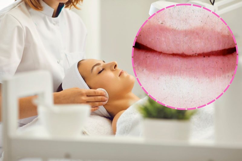 eliminar los puntitos negros en los labios